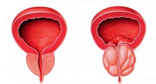 prostate saine et enflammée avec prostatite chronique