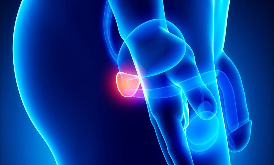 Inflammation de la prostate avec prostatite