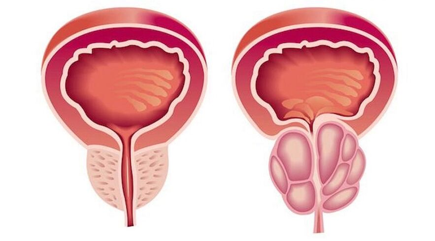 Prostate sain et enflammée de prostatite