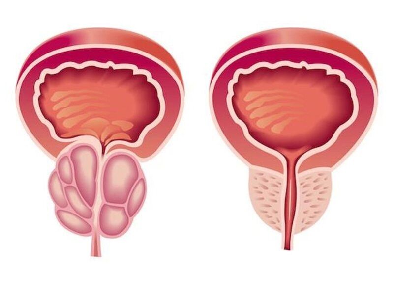 Comment la prostatite apparaît